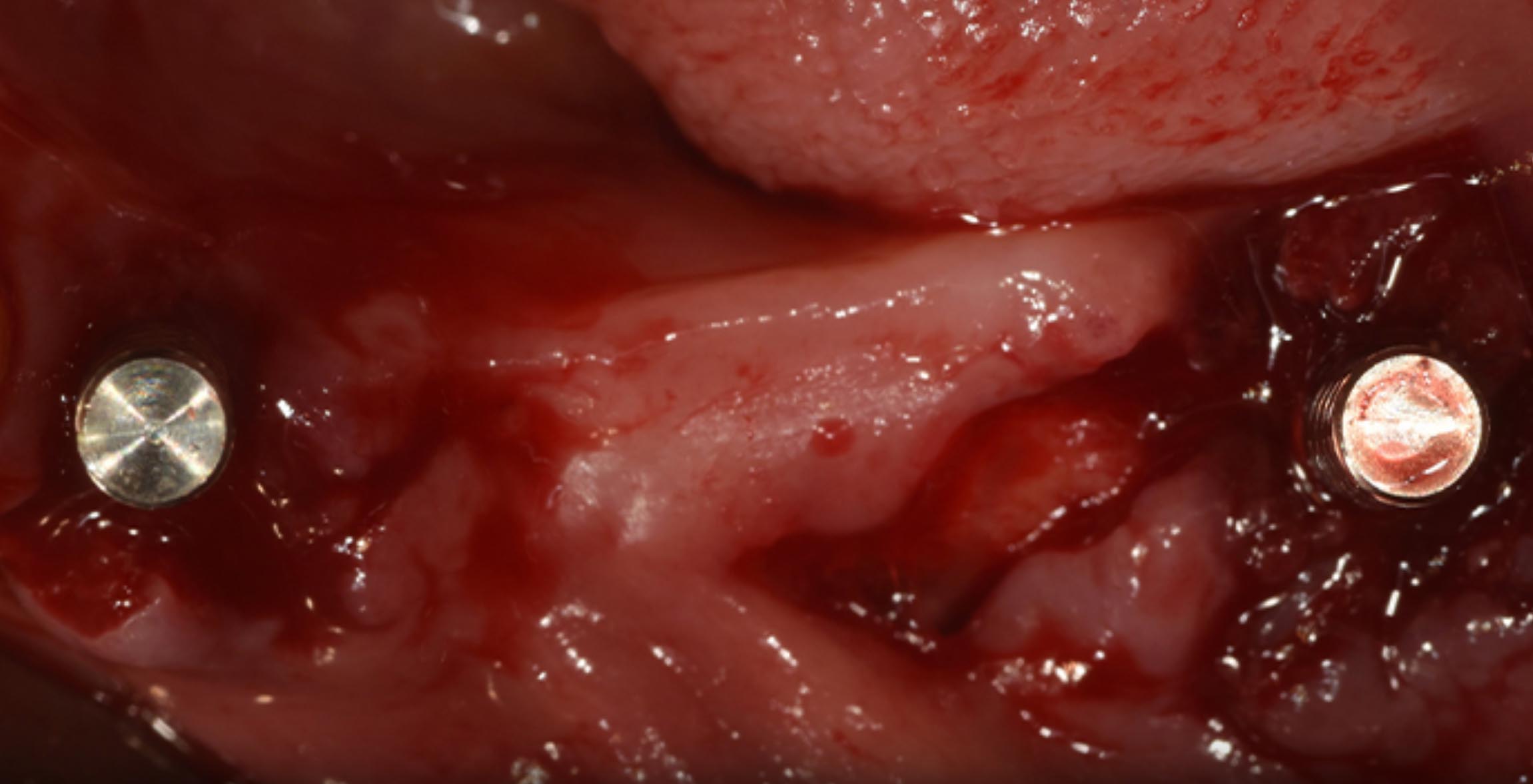 Immediate implant
