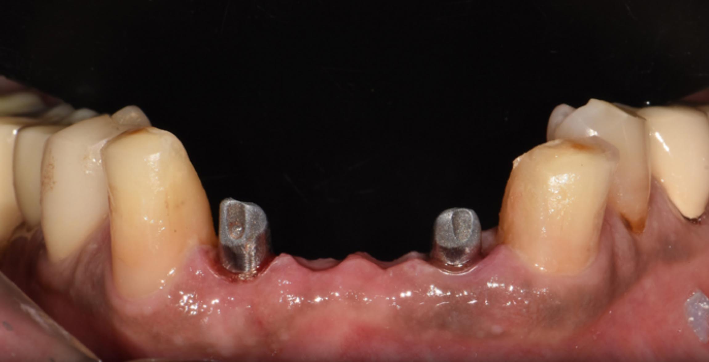 Use of Bright Tissue